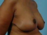 Patient # 32675 After Photo # 4